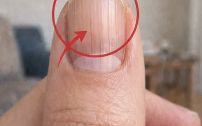 Ein Arzt entdeckt ein verräterisches Zeichen in Ihren Fingernägeln, das Ihre Lebenserwartung vorhersagen könnte.
