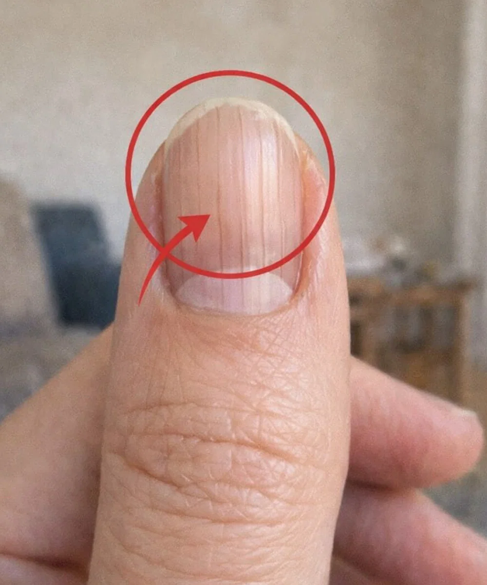 Ein Arzt entdeckt ein verräterisches Zeichen in Ihren Fingernägeln, das Ihre Lebenserwartung vorhersagen könnte.